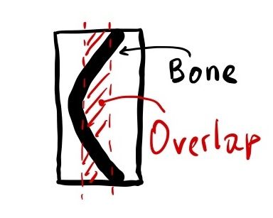 The profile of bone connecting to the joint bends allowing for the extra overlap